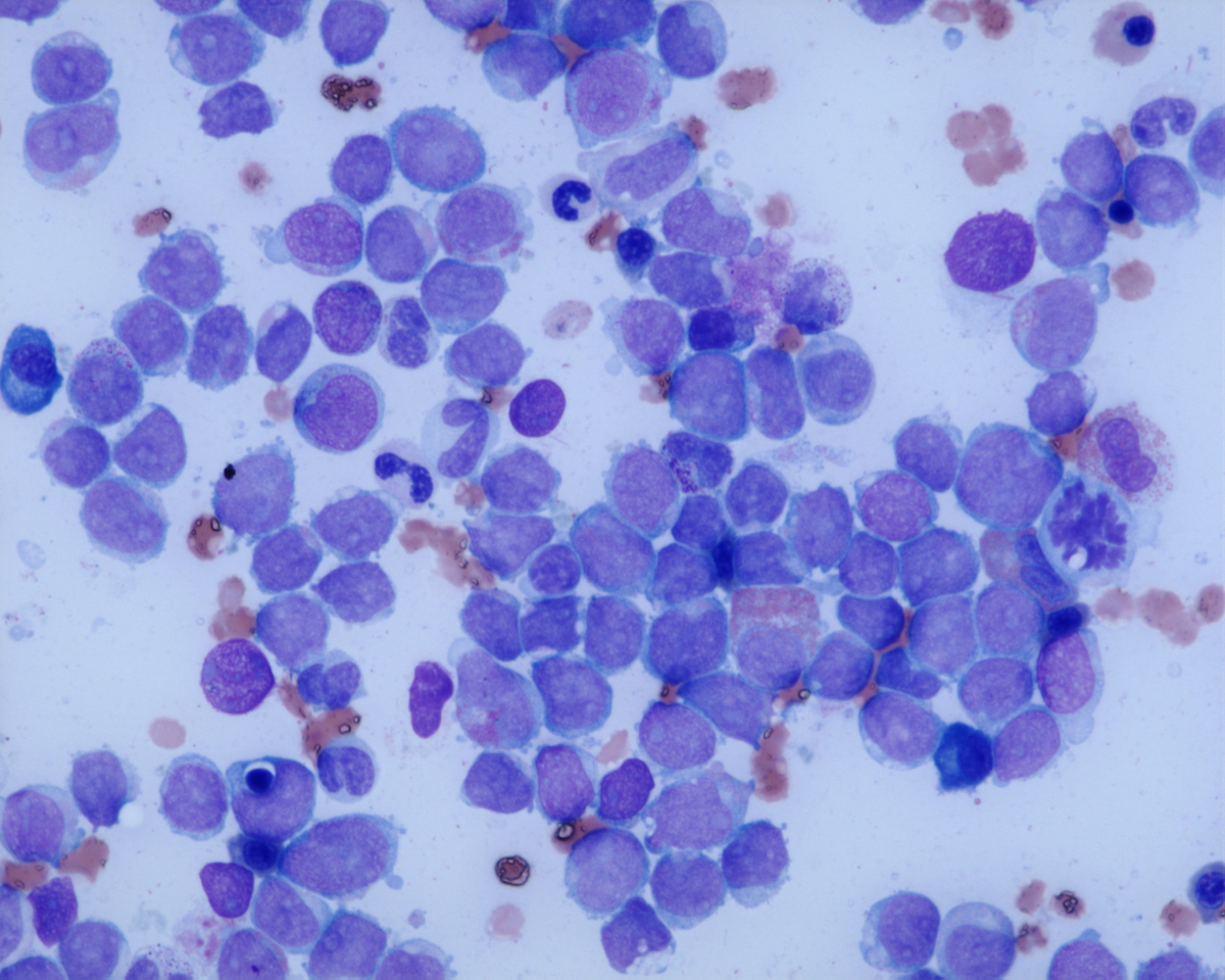 Bone marrow aspirate smear with increased myeloblasts.